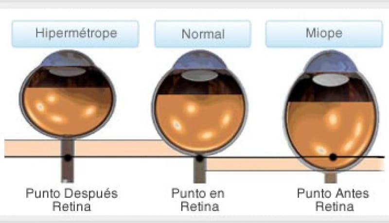 Qué son los Defectos Refractivos