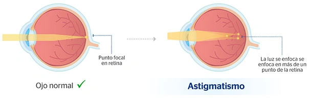 Astigmatismo y sus tipos