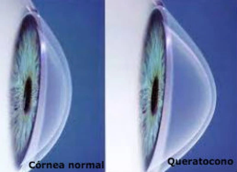 Modernos tratamientos para detener el queratocono