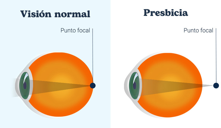 cirugía de presbicia