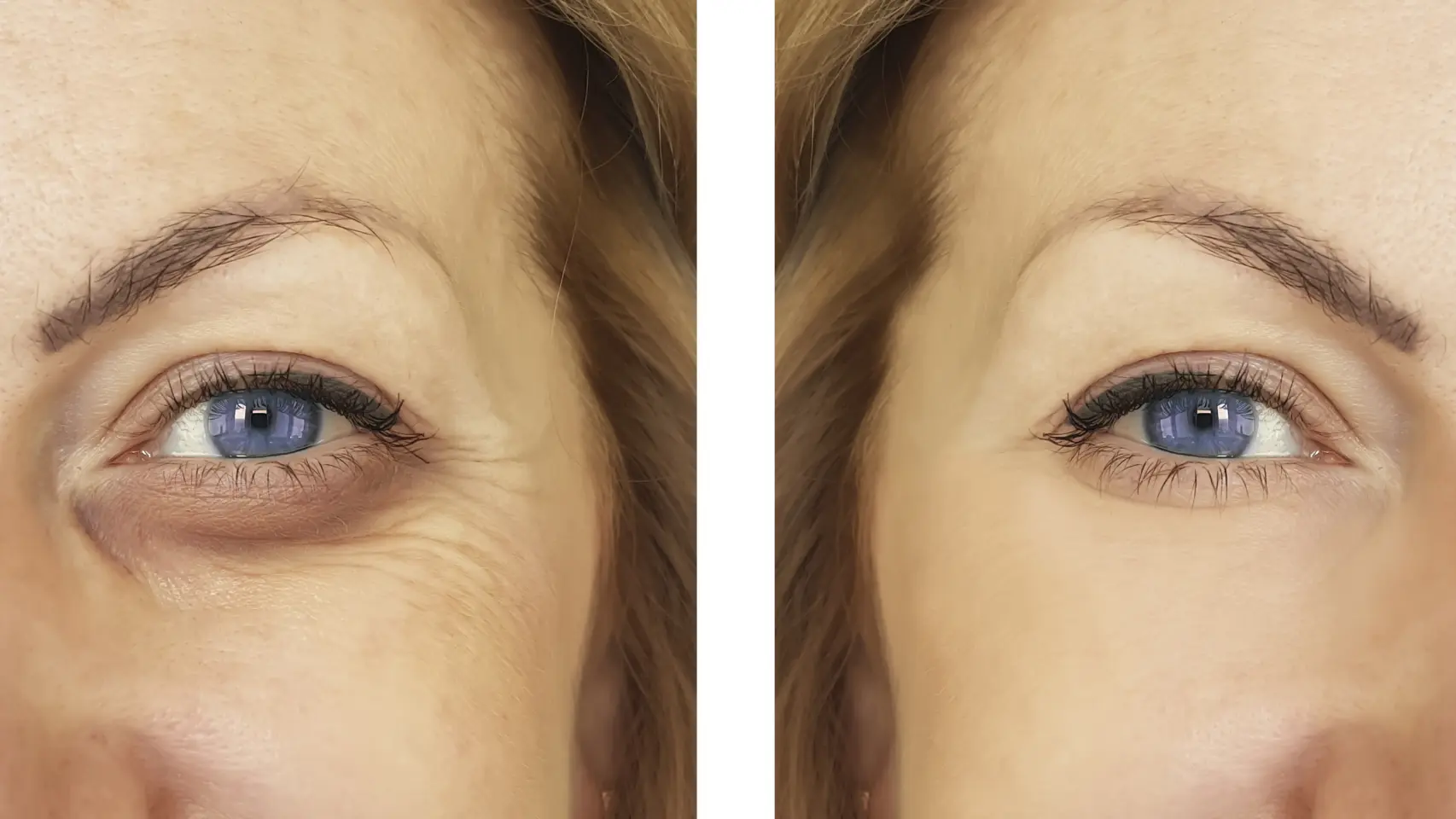 ¿Cómo rejuvenecer el contorno de ojos?