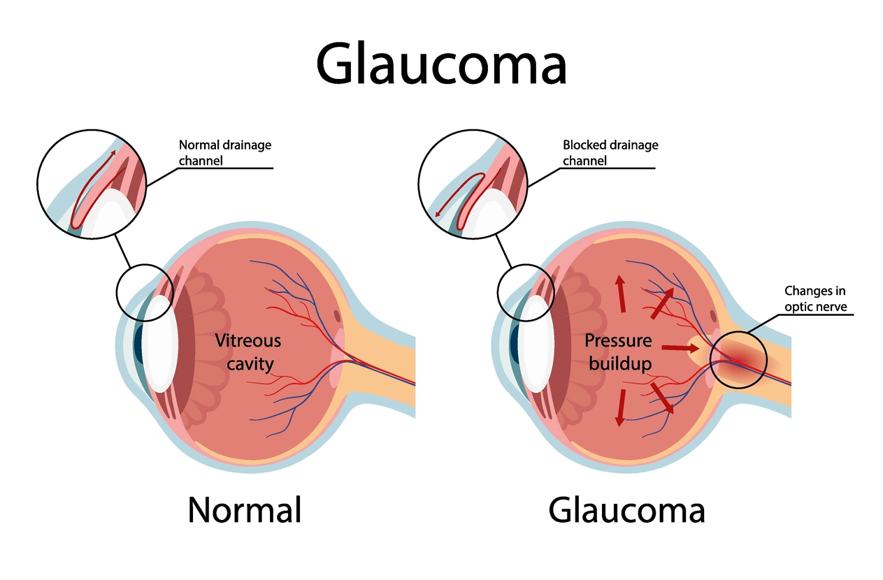 Riesgo de glaucoma