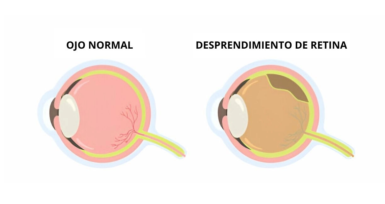 ¿Por qué ocurre el desprendimiento de retina?
