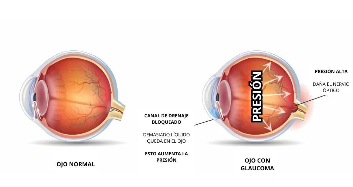 ¿Cómo se desarrolla el glaucoma en el ojo?
