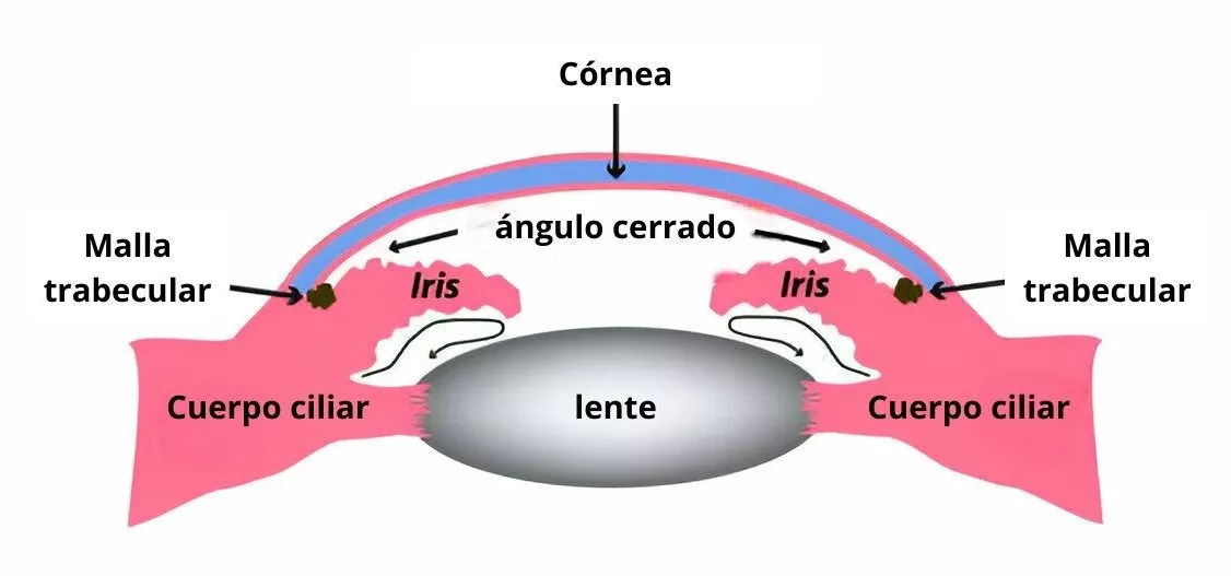 Glaucoma de ángulo cerrado