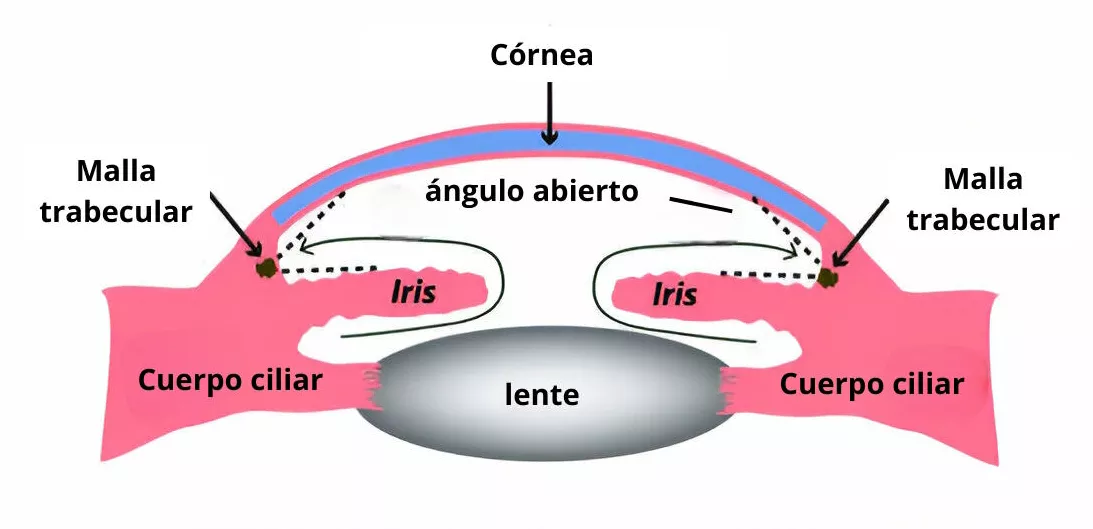 Glaucoma de ángulo cerrado