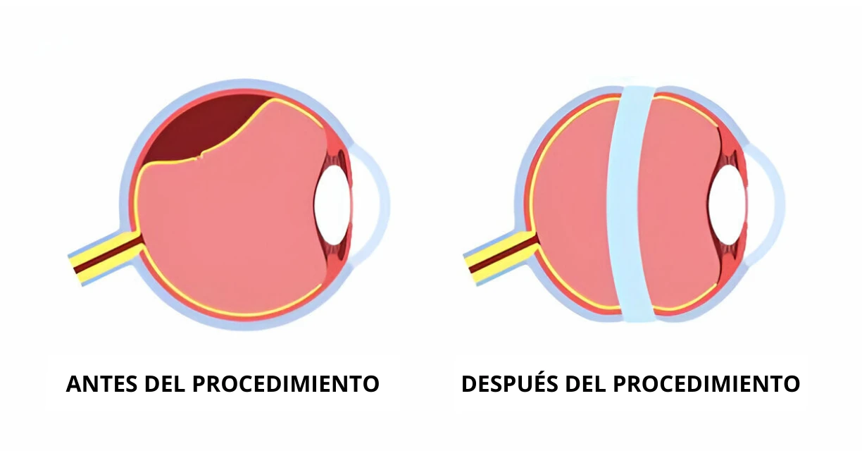 Cuidados postoperatorios y recuperación visual
